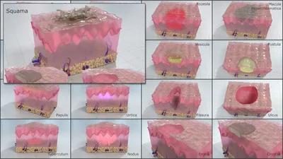 Сыпь. Первичные морфологические элементы сыпи.