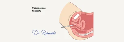 Увеличение точки G | Клиника Золотое Правило | Дзен