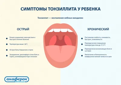 Тонзиллит у ребенка: что делать? Профилактика и лечение тонзиллита у детей