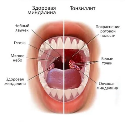 Тонзиллит и его лечение | Врачебная Династия | Дзен