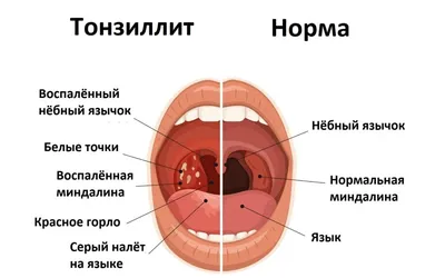 Хронический тонзиллит: симптомы, причины и методы лечения болезни