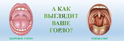 Хронический тонзиллит - признаки, причины, симптомы, лечение и профилактика  - 