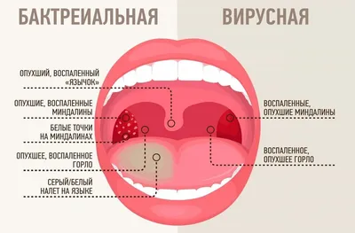 Тонзиллит лечение у детей и взрослых в ЛОР Клинике Оренбург