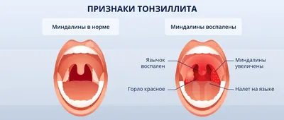 Лечение тонзиллита в Барнауле