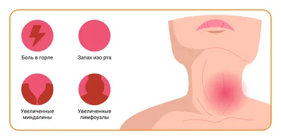 Лечение хронического тонзиллита: что важно знать пациенту