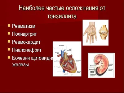 Тонзиллит: симптомы и признаки тонзиллита читайте в статье блога Furasol®