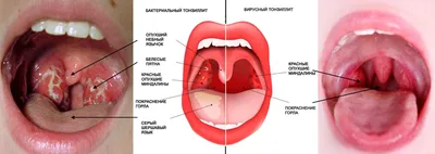 Лечение хронического тонзиллита в Уфе — Клиника Лазер и здоровье