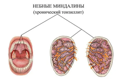 Лечение тонзиллита в Москве лазером - цена от 2500 руб