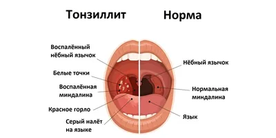 Тонзиллит: лечение хронического тонзиллита у детей и взрослых, острый  тонзиллит, симптомы, как лечить