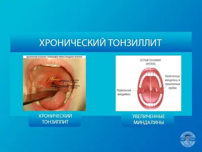 Хронический тонзиллит - Клиника в Праге MEDICA MENTE