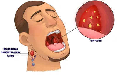Как лечить хронический тонзиллит: эффективный метод лечения