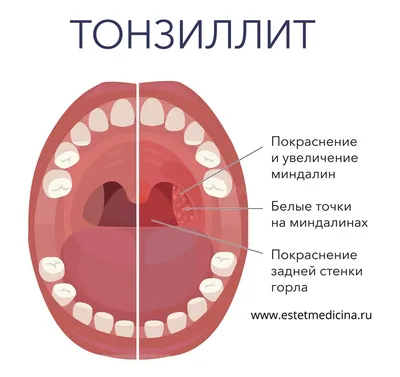 Хронический тонзиллит. Журнал «Найз Здоровье»! :- Medznat