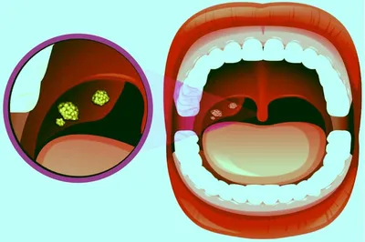 Классификация и признаки хронического тонзиллита