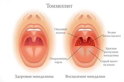 Хронический тонзиллит: возможно ли добиться ремиссии? | Медицинский центр  Е.В. Малышевой | Дзен