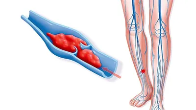 Средства народной медицины, используемые при лечении тромбофлебита |  Народная медицина | Дзен