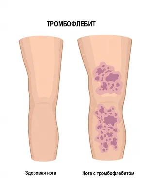 Тромбофлебита картинки