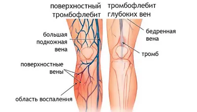 Лечение тромбоза и тромбофлебита нижних конечностей - «Институт Вен»  лечение варикоза в Киеве и Харькове