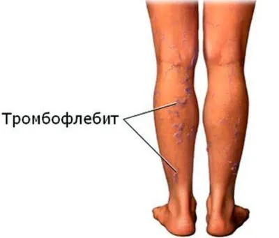 Тромбоз и тромбофлебит поверхностных вен нижних конечностей ⋆  