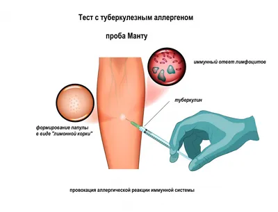 Туберкулез: легких, кожи, костей, пр; симптомы и лечение