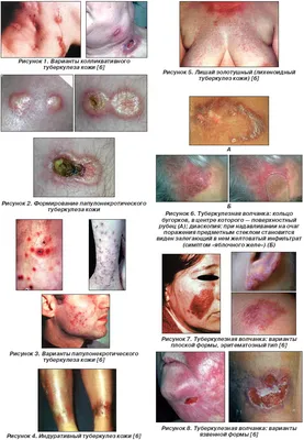 Туберкулез кожи | Інтернет-видання "Новини медицини та фармації"