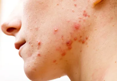 Чем опасна угревая сыпь на лице? | Как мама | Дзен