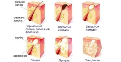 Как избавиться от акне (угревой сыпи)? Методы лечения