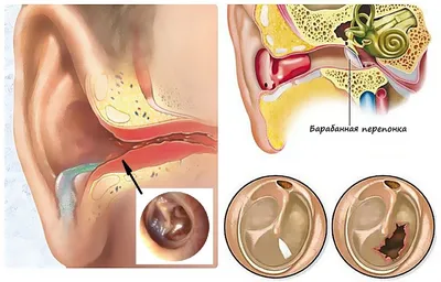 Заложило ухо: что делать, советы врача | РБК Стиль