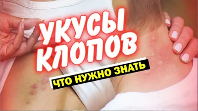 В Ашхабаде участились случаи госпитализации после укусов клопов