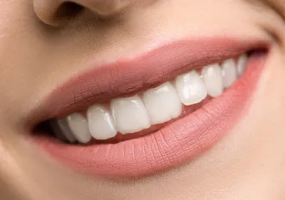 Veneers Cost - Orthodontix Dental Clinic - Hollywood Smile in Dubai |  Cosmetic Dentistry Dubai - Orthodontix Dental Clinic