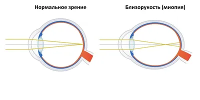 Близорукость - причины, степени, лечение - Оптик Сити