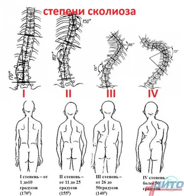 Лечение сколиоза у детей — передовые методики в НМИЦ им. Г. И. Турнера -