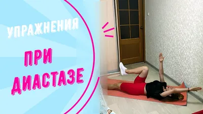 Диастаз прямых мышц