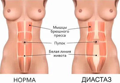 Какие упражнения на пресс можно делать при диастазе, а какие нет