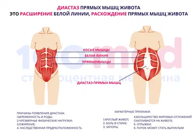 Как самостоятельно определить диастаз живота? - Исамутдинова Г. М.