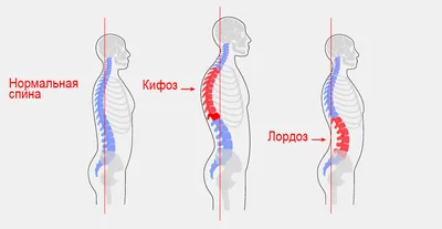 ЛФК при сколиозе и плоскостопии