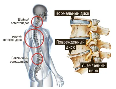 Упражнения при грыже поясничного отдела позвоночника