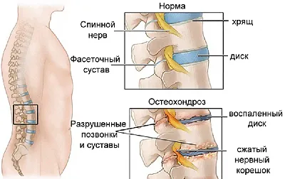 Можно ли тренироваться при остеохондрозе?