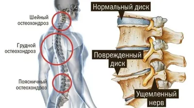 Лечение протрузии грудного отдела позвоночника в Екатеринбурге - Новая  больница