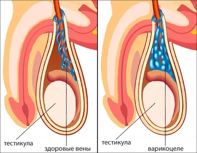 Варикоцеле 64 картинки