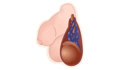 Варикоцеле (варикоз яичек) лечение в Украине | Клиника Биляка