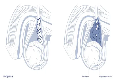 Операции по лечению варикоцеле | Москва