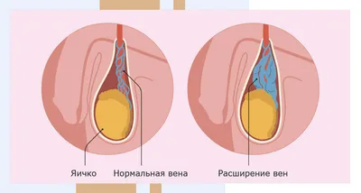 Операция по удалению у мужчин варикоцеле в Москве