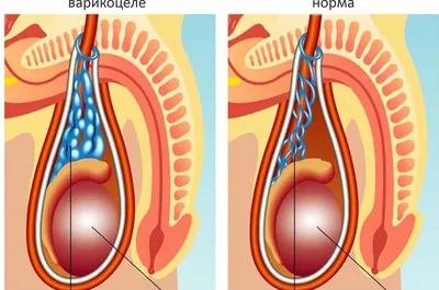 Варикоцеле у мужчин - Центр ЭКО