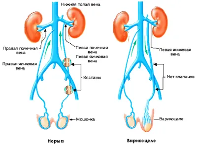Варикоцеле у мужчин - причины, симптомы, диагностика и лечения в ИСЦ