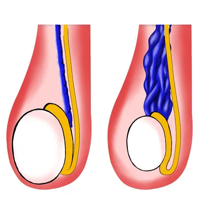 Варикоцеле: причины, симптомы и лечение в Клинике АльтраВита