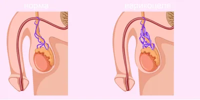 Варикоцеле | ТС Клиника — г. Краснодар
