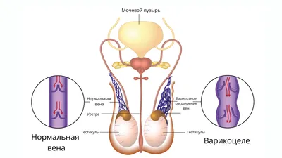 Варикоцеле - Минск