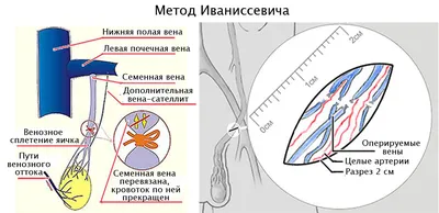 Лечение Варикоцеле и операция по Мармару в Одессе | Уролог андролог  Брезицкий Юрий Иосифович