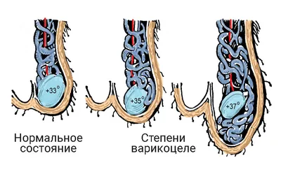 Варикоцеле у детей