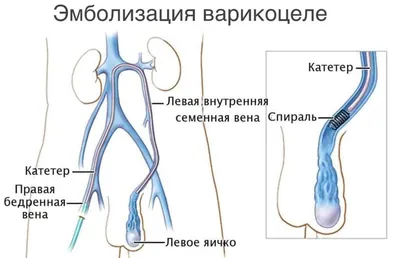 Варикоцеле - Новая мировая хирургия